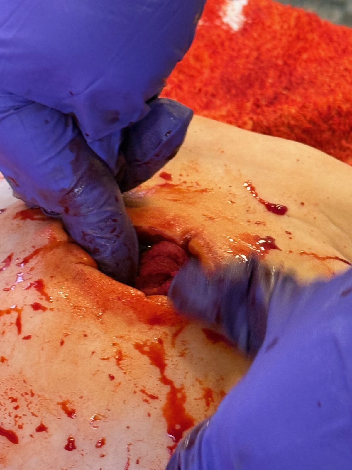 A bleeding wound being packed with a haemostat dressing on a First Aid course.