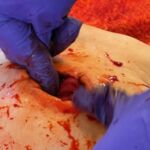 A bleeding wound being packed with a haemostat dressing on a First Aid course.
